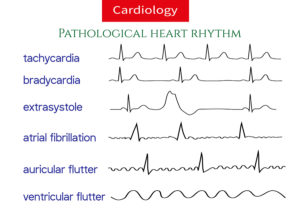 Naturally Eliminate Heart Arrhythmia - Dan Hammer Health LTD